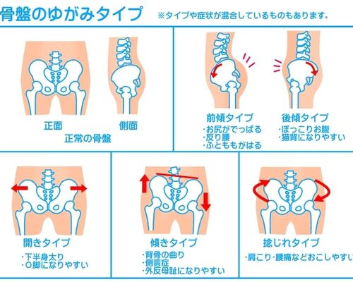 骨盤のゆがみ